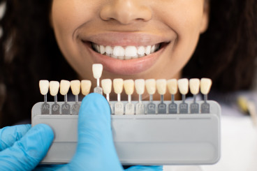 Save on Dental Veneers to Transform Your Smile in One Appointment
