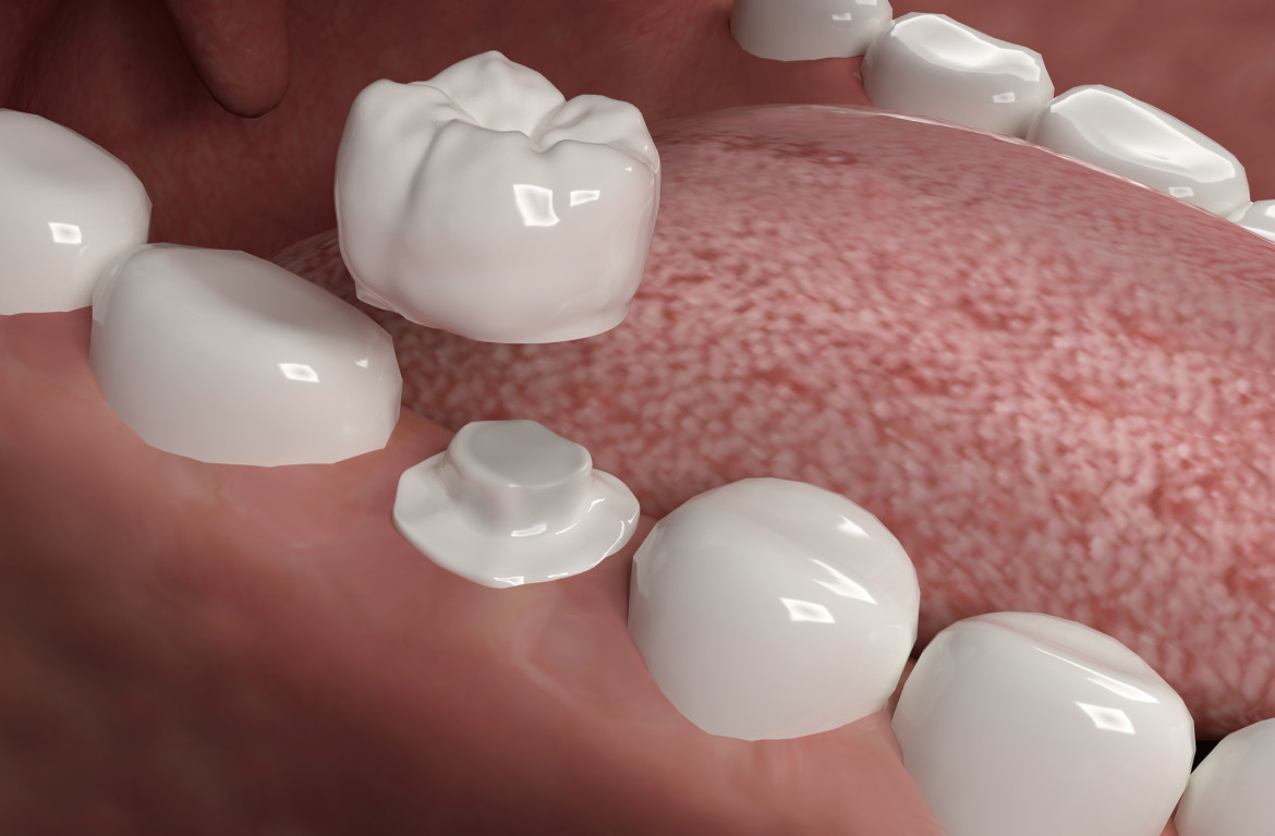 The Many Benefits of Dental Crowns