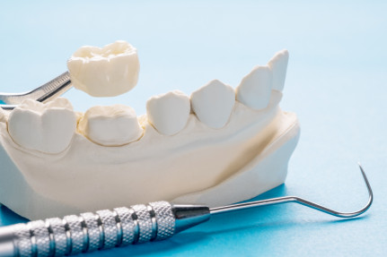 Complete Guide to Getting Dental Crowns | Dr. BestPrice