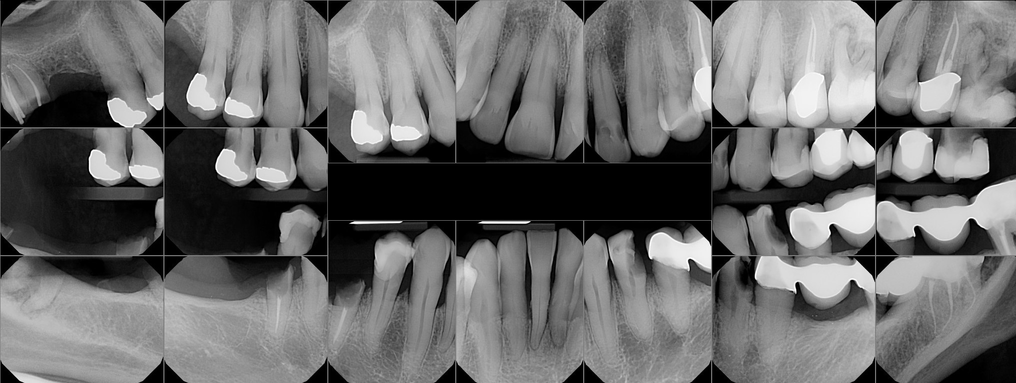 Attachment x-rays for implants