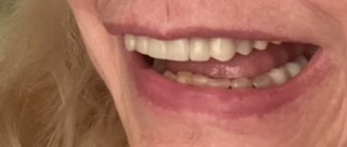 mouth left side