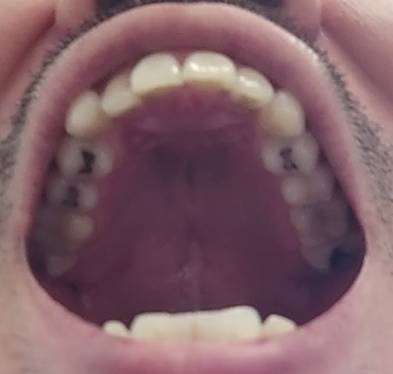 mouth upper arch mouth upper arch