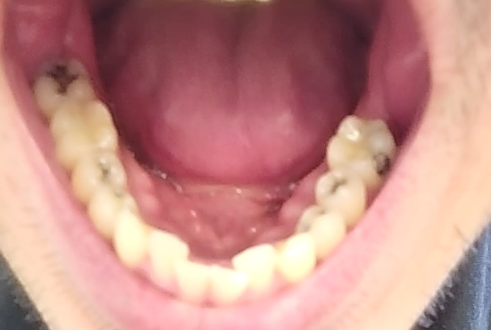 mouth lower arch mouth lower arch