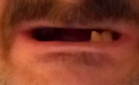 mouth left side mouth left side
