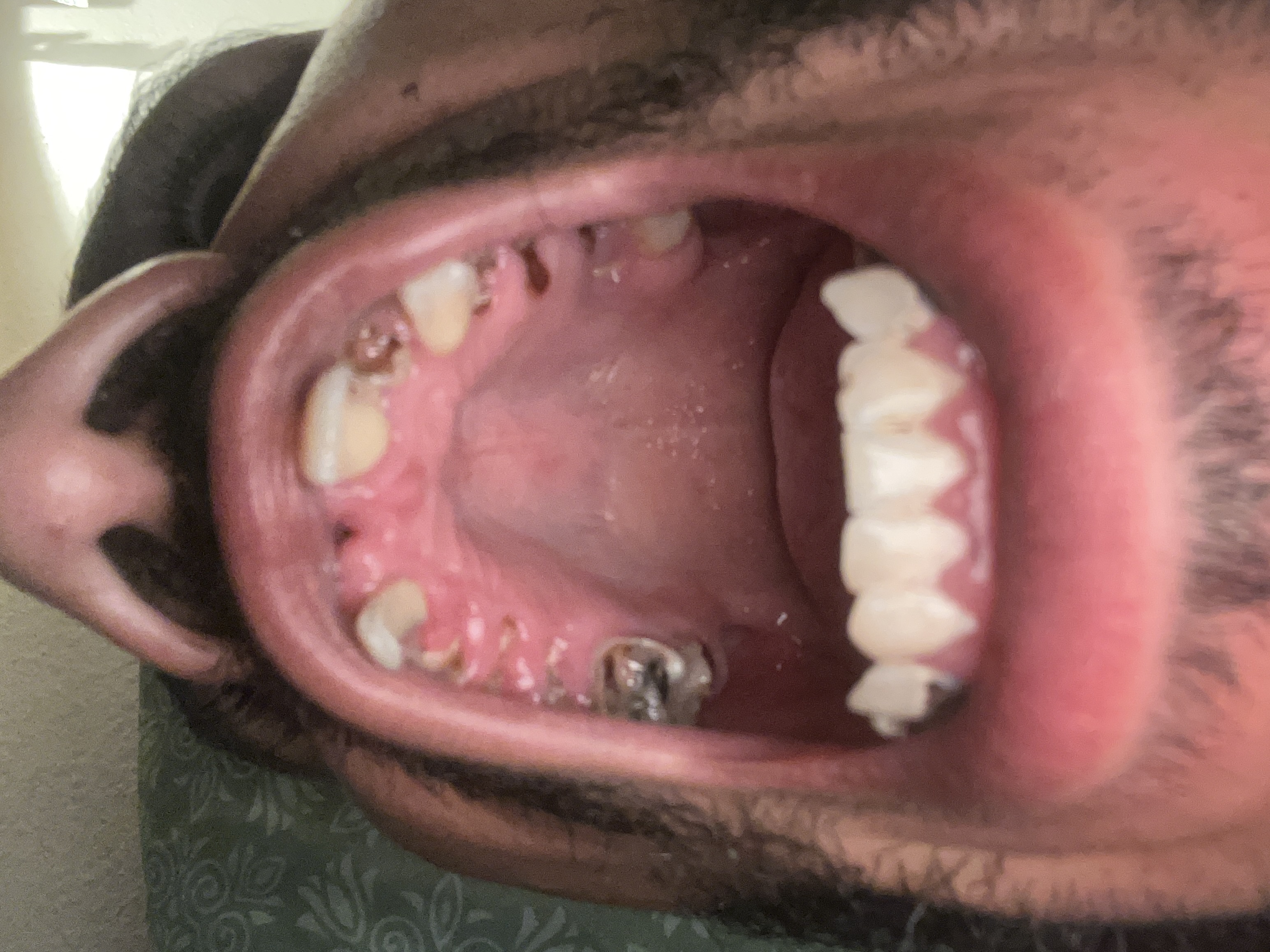 mouth upper arch