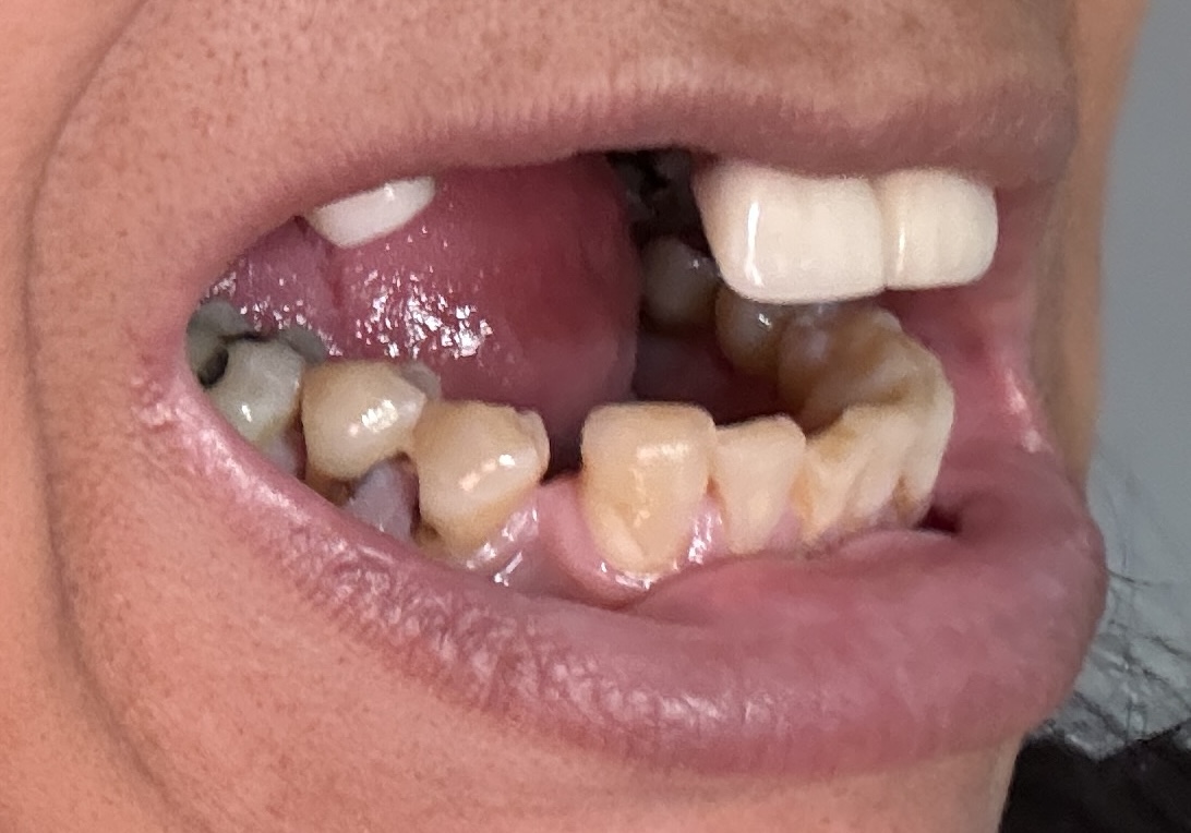 mouth left side