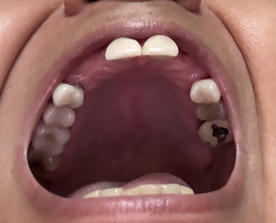 mouth upper arch